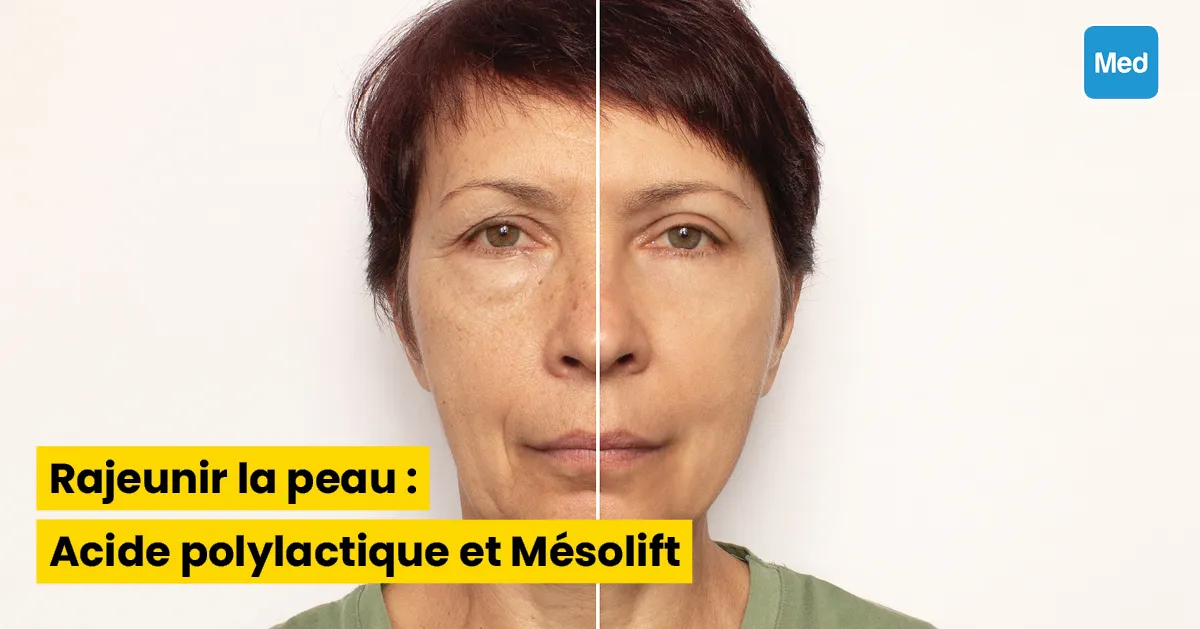 Rajeunir la peau : Acide polylactique et Mésolift